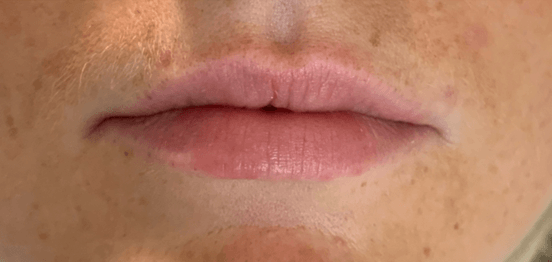 Lips before (1).png