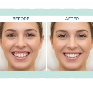 Treating a Gummy Smile with Botox: How It Works and What to Look For
