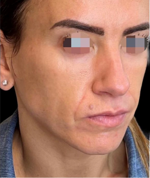 mid to lower face dermal filler - before.ed410a02c01fd52e71cce1c879a5359d6236a91fcef0676984578ee7b9df519e.png