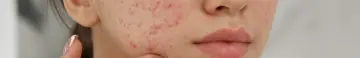 How to get rid of acne scars blog.png