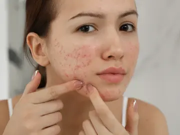 How to get rid of acne scars blog.png