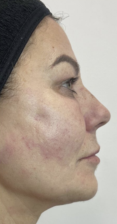 after sculptra.png