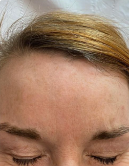 After botox.png