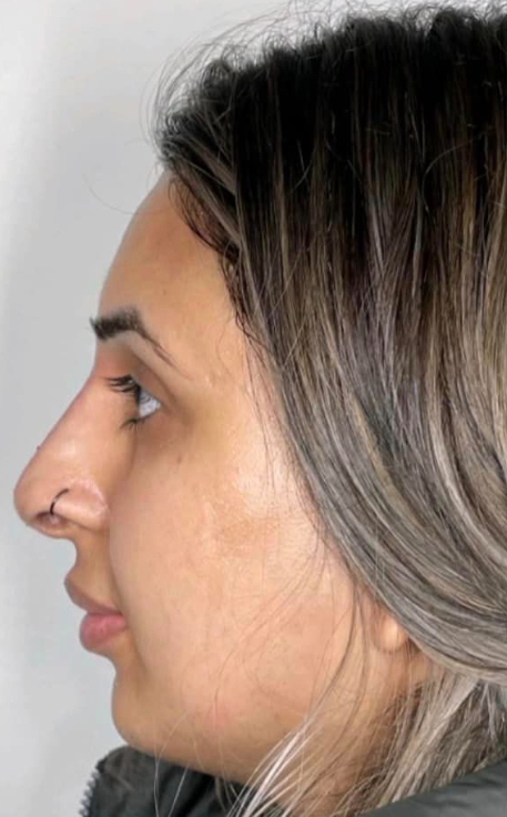 after nose x2.png