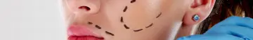thread lift vs facelift.png