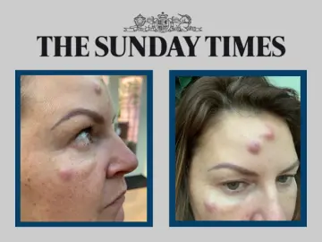 times botched botox.png