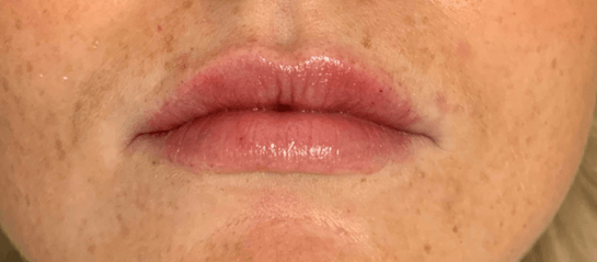 Lips after (1).png