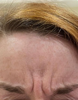 Before botox.png