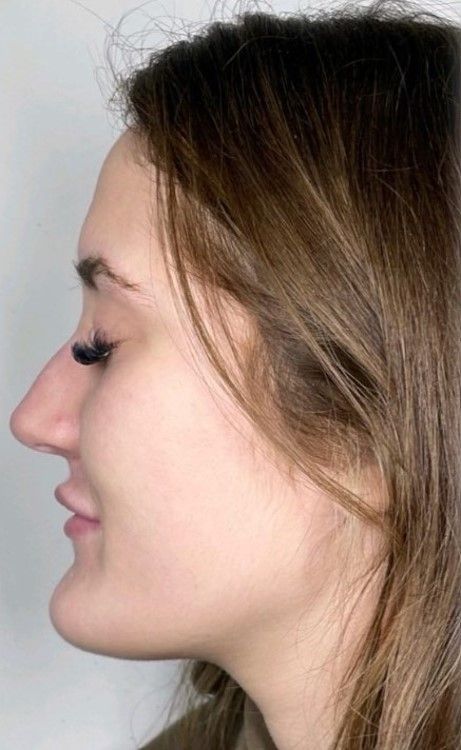 before nose.jpg