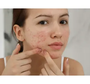 How to Get Rid of Acne Scars Safely: Laser, Microneedling, or Peels?